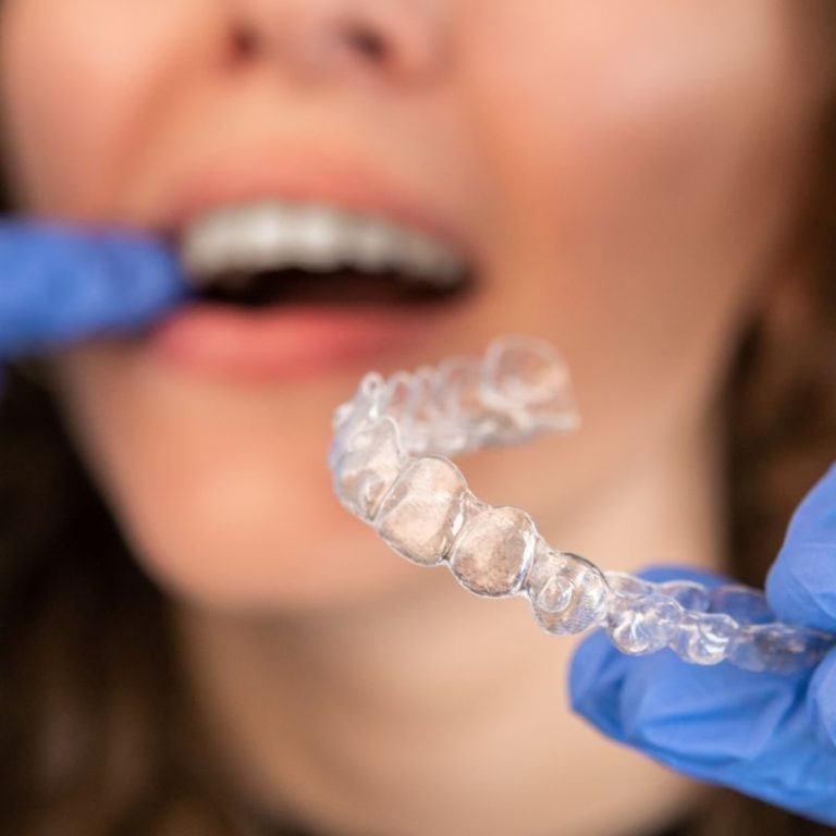 Are Clear Aligners Effective