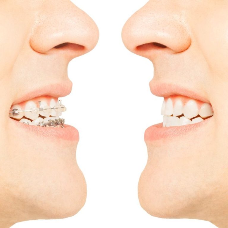 Clear Aligners vs. Braces
