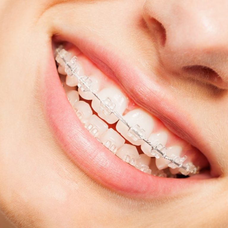 Clear ceramic braces