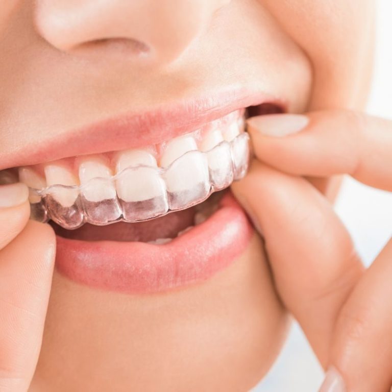 How Do Clear Aligners Work