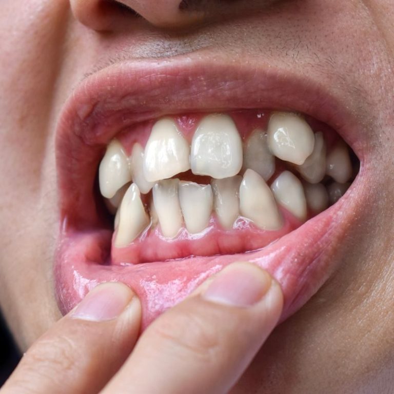 What Clear Aligners Cannot Fix