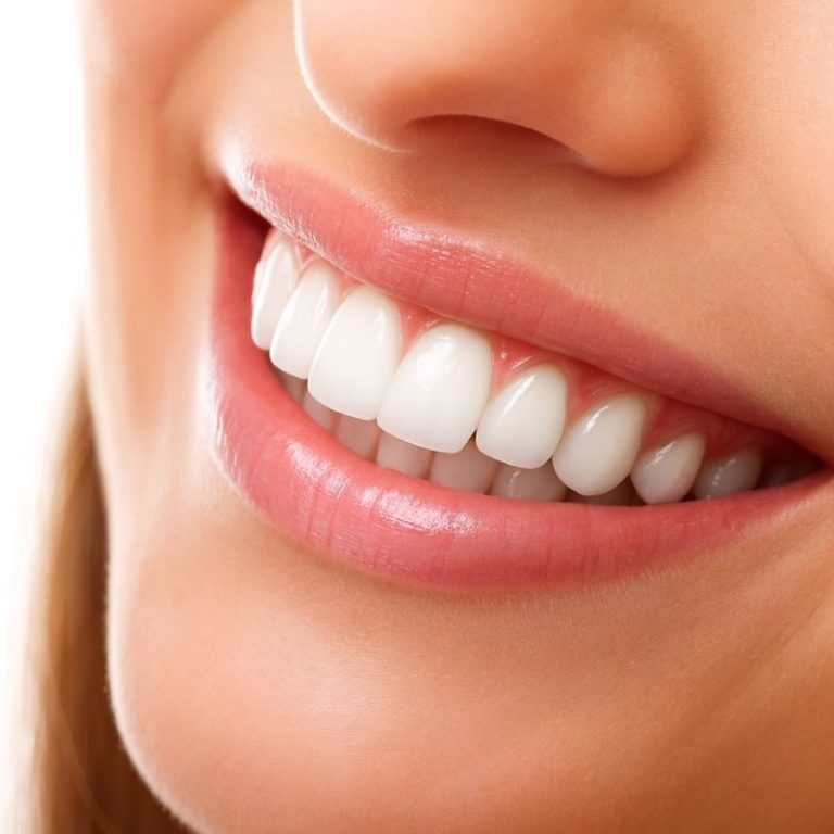 clear aligners for overbite